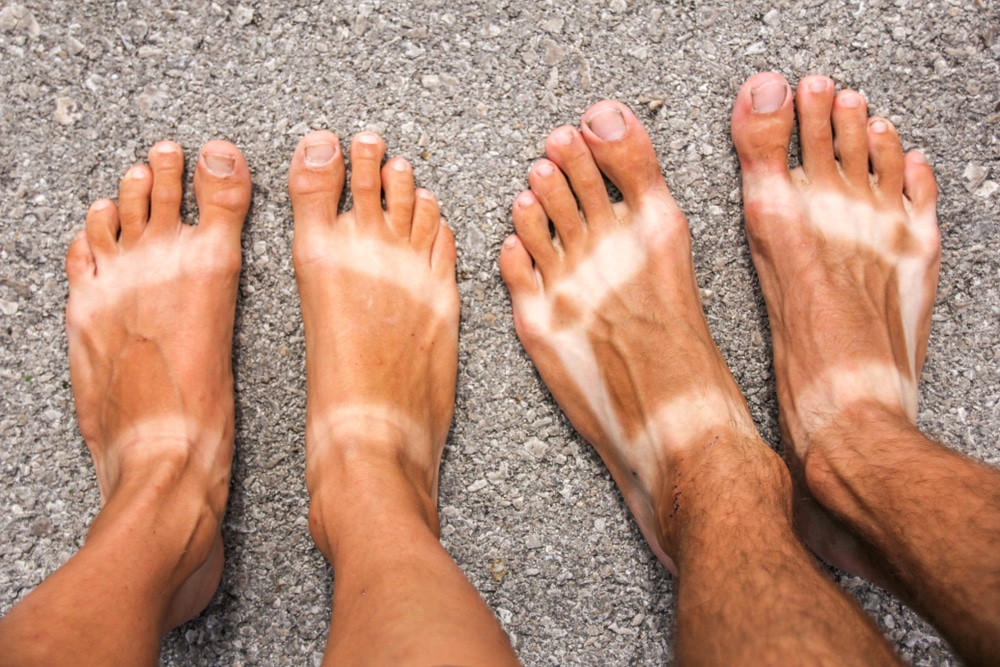 Sunburns on feet