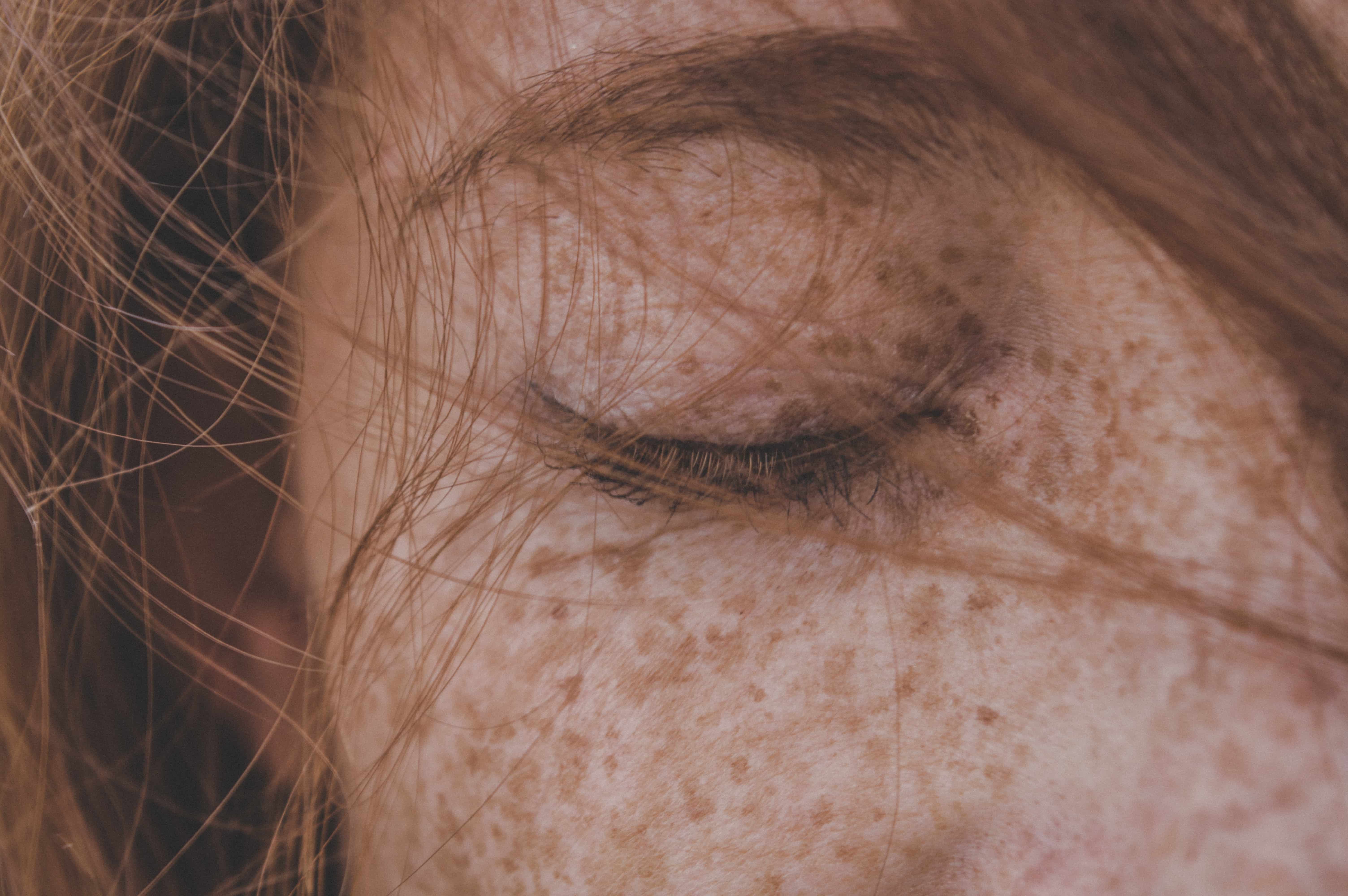 A woman with freckles on her skin