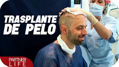 My Experience Getting a Hair Transplant